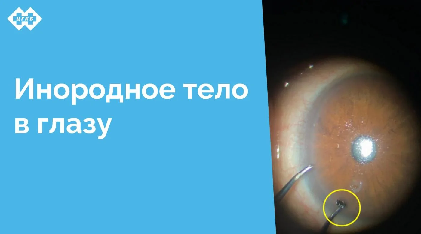 К врачу-офтальмологу Центральной городской клинической больницы обратился мужчина с жалобами на инородное тело в глазу. При осмотре это оказался металлический осколок. Со слов пациента травма получена несколько недель назад и доставляла ему дискомфорт