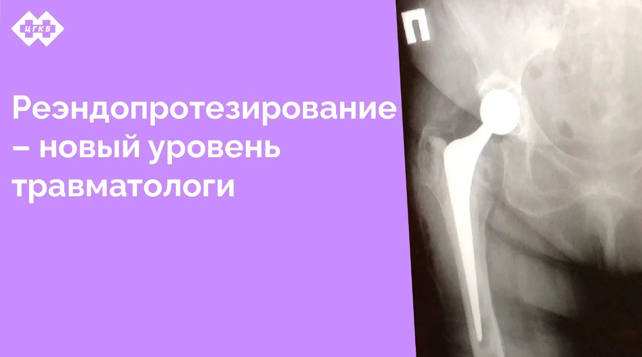 Необходимость повторного протезирования тазобедренного сустава – серьезная проблема, возникшая в последние годы у пациентов, перенесших установку протезов, и нуждающихся в их замене