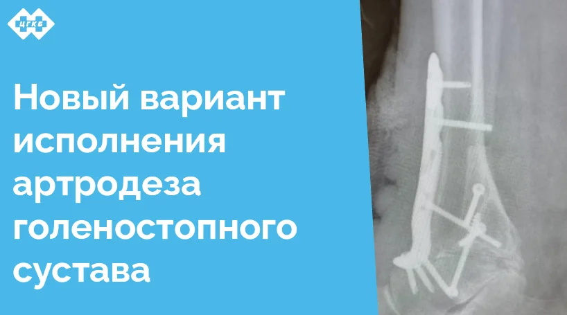 В отделении травматологии и ортопедии Центральной городской клинической больницы успешно выполнен уникальный вариант исполнения артродеза голеностопного сустава, который стал значительным шагом вперёд в восстановительной хирургии