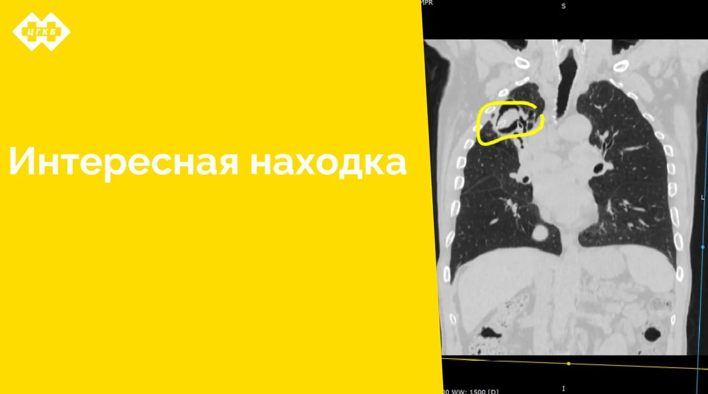 Дренажная трубка длиной 11 см в легком стала «случайной» находкой у сотрудников отделения лучевой диагностики ЦГКБ
