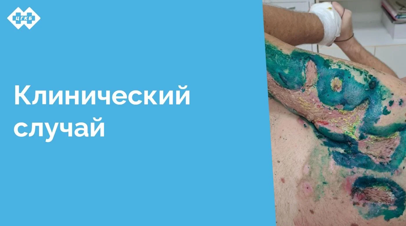 Лечение обширных постнекротических ран представляет собой сложную задачу, требующую комплексного подхода и индивидуальной тактики