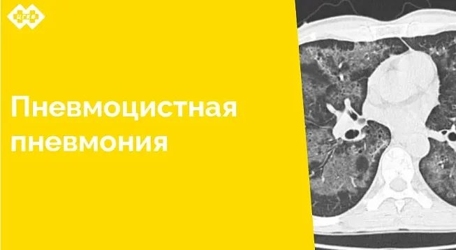 По результатам проведенного компьютерно-томографического исследования специалистам лучевой диагностики удалось успешно разобраться с нозологической формой заболевания клинически сложного пациента, находящегося на стационарном лечении