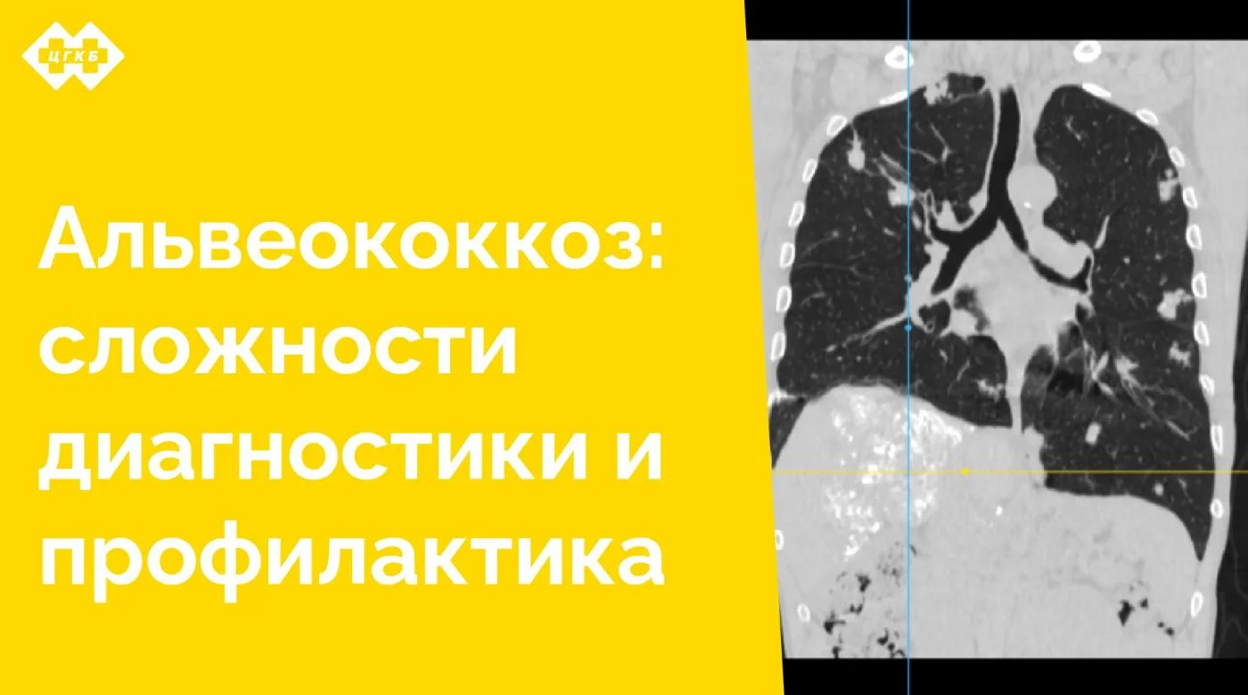 Альвеококкоз (или альвеолярный эхинококкоз) – это редкий природно-очаговый гельминтоз, вызываемый ленточным червем Alveococcus multilocularis. Заболевание длительно протекает бессимптомно и может быть «случайной» находкой при плановом обследовании