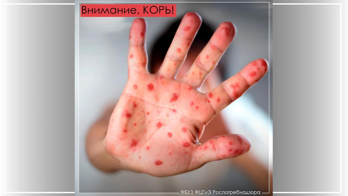 Внимание, корь!