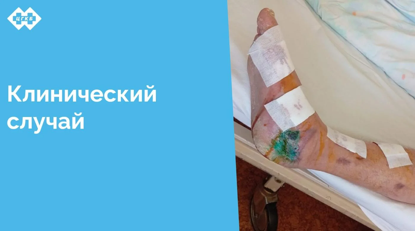 Этот случай демонстрирует высокую эффективность командной работы и применения современных медицинских технологий в лечении сложных травм. Минно-взрывные ранения отличаются тяжестью повреждений, сочетанием переломов, обширных дефектов мягких тканей