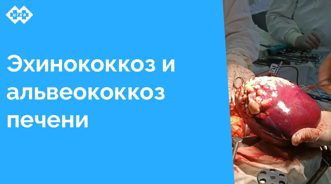 В больницу поступили два пациента с опасными паразитарными заболеваниями — эхинококкозом и альвеококкозом печени