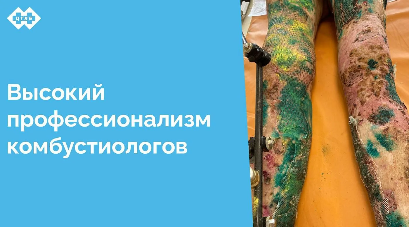 Врачи ожогового отделения Центральной городской клинической больницы в короткие сроки восстановили кожный покров пациенту с обширными глубокими ранами