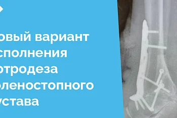 В отделении травматологии и ортопедии Центральной городской клинической больницы успешно выполнен уникальный вариант исполнения артродеза голеностопного сустава, который стал значительным шагом вперёд в восстановительной хирургии