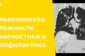 Альвеококкоз (или альвеолярный эхинококкоз) – это редкий природно-очаговый гельминтоз, вызываемый ленточным червем Alveococcus multilocularis. Заболевание длительно протекает бессимптомно и может быть «случайной» находкой при плановом обследовании