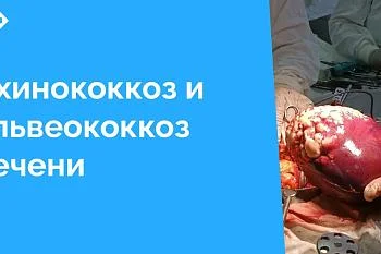 В больницу поступили два пациента с опасными паразитарными заболеваниями — эхинококкозом и альвеококкозом печени