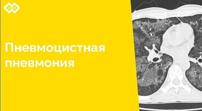 По результатам проведенного компьютерно-томографического исследования специалистам лучевой диагностики удалось успешно разобраться с нозологической формой заболевания клинически сложного пациента, находящегося на стационарном лечении