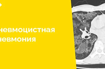 По результатам проведенного компьютерно-томографического исследования специалистам лучевой диагностики удалось успешно разобраться с нозологической формой заболевания клинически сложного пациента, находящегося на стационарном лечении