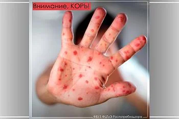 Внимание, корь!