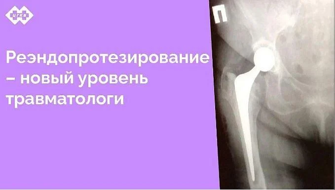 Необходимость повторного протезирования тазобедренного сустава – серьезная проблема, возникшая в последние годы у пациентов, перенесших установку протезов, и нуждающихся в их замене