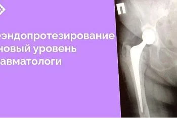 Необходимость повторного протезирования тазобедренного сустава – серьезная проблема, возникшая в последние годы у пациентов, перенесших установку протезов, и нуждающихся в их замене