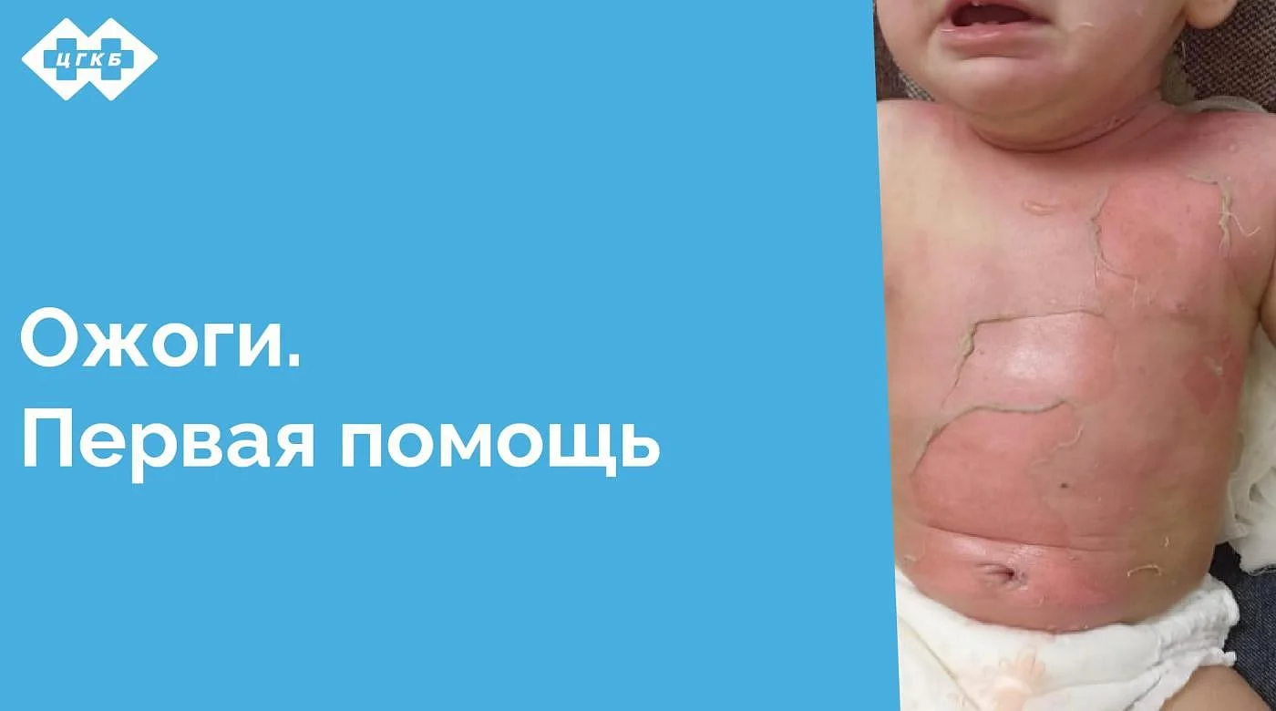 В Центральной городской клинической больнице работает единственное в области ожоговое отделение. Именно сюда привозят пациентов с ожогами кипятком, пламенем, от контакта с горячими предметами, обморожениями, электротравмами