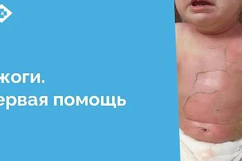 В Центральной городской клинической больнице работает единственное в области ожоговое отделение. Именно сюда привозят пациентов с ожогами кипятком, пламенем, от контакта с горячими предметами, обморожениями, электротравмами