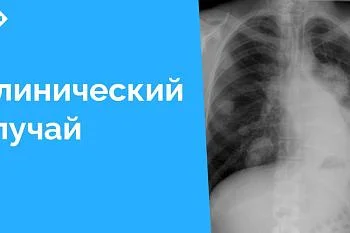 Интересный клинический случай: почему нельзя пренебрегать профилактической флюорографией