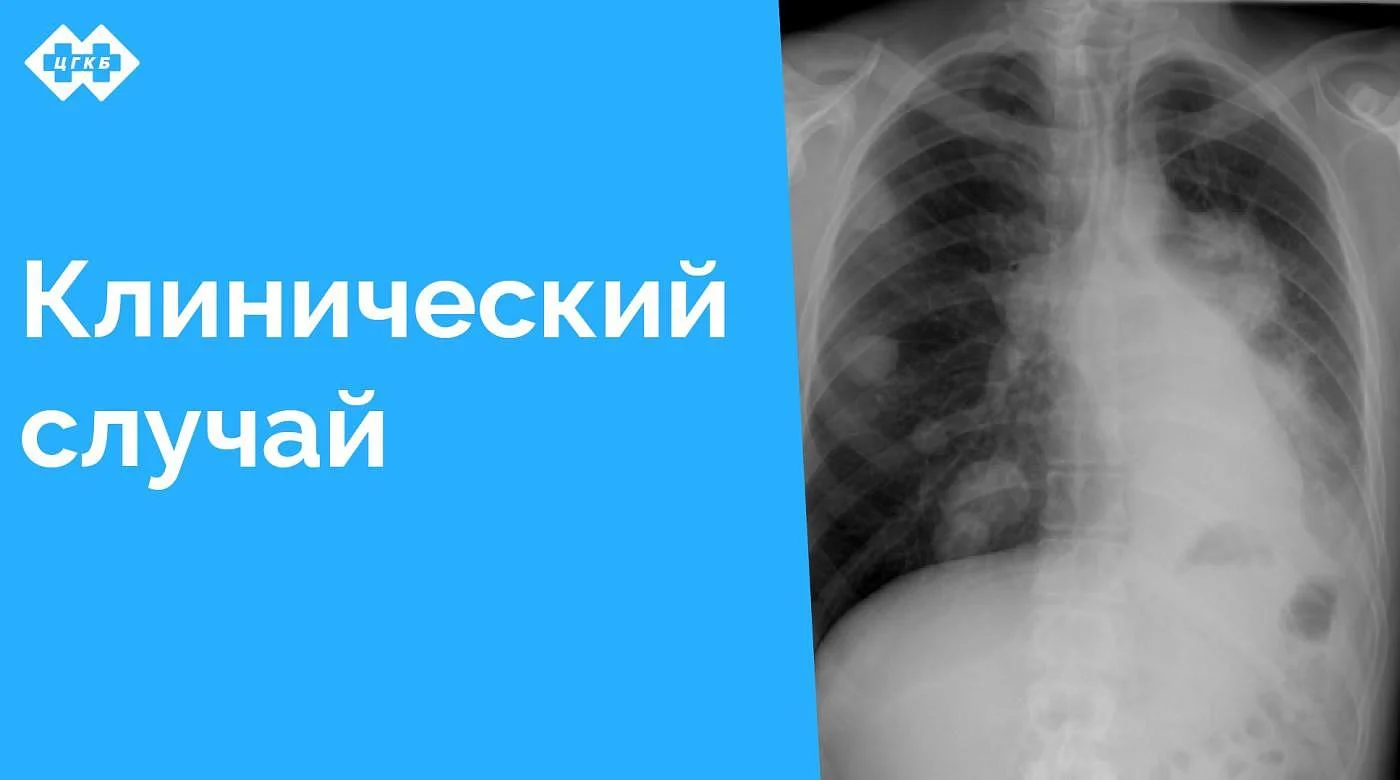 Интересный клинический случай: почему нельзя пренебрегать профилактической флюорографией Интересный клинический случай: почему нельзя пренебрегать профилактической флюорографией
