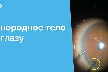 К врачу-офтальмологу Центральной городской клинической больницы обратился мужчина с жалобами на инородное тело в глазу. При осмотре это оказался металлический осколок. Со слов пациента травма получена несколько недель назад и доставляла ему дискомфорт