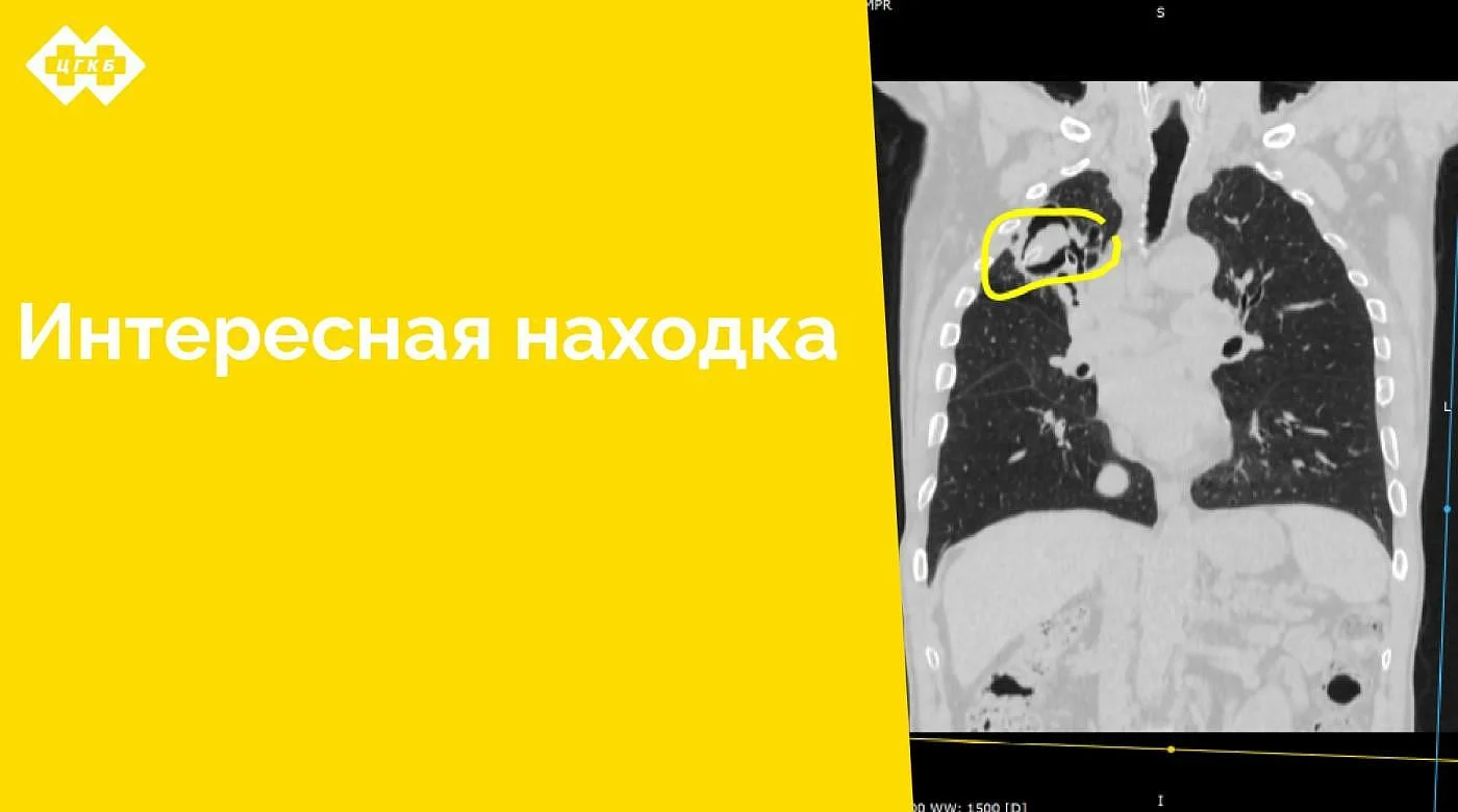 Дренажная трубка длиной 11 см в легком стала «случайной» находкой у сотрудников отделения лучевой диагностики ЦГКБ