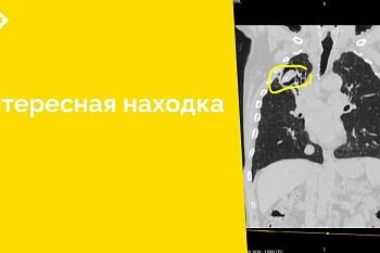 Дренажная трубка длиной 11 см в легком стала «случайной» находкой у сотрудников отделения лучевой диагностики ЦГКБ