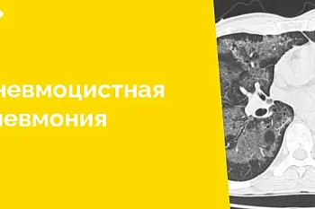 По результатам проведенного компьютерно-томографического исследования специалистам лучевой диагностики удалось успешно разобраться с нозологической формой заболевания клинически сложного пациента, находящегося на стационарном лечении