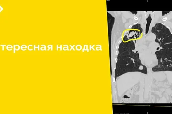 Дренажная трубка длиной 11 см в легком стала «случайной» находкой у сотрудников отделения лучевой диагностики ЦГКБ