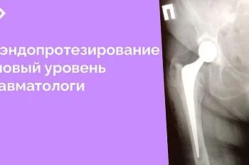 Необходимость повторного протезирования тазобедренного сустава – серьезная проблема, возникшая в последние годы у пациентов, перенесших установку протезов, и нуждающихся в их замене