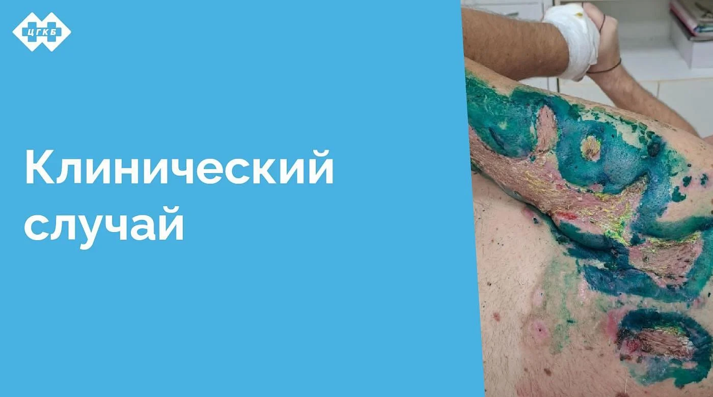 Лечение обширных постнекротических ран представляет собой сложную задачу, требующую комплексного подхода и индивидуальной тактики